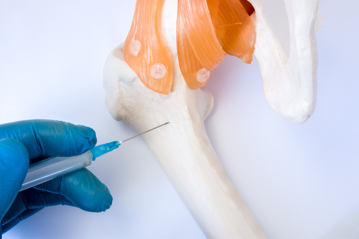 Bone marrow examination procedure: biopsy, aspiration or paracentesis concept photo. Doctor holds in hand dressed in glove syringe needle and puncture model of hip bone to take analysis of bone marrow