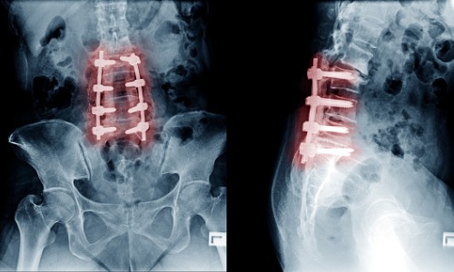 xray-image-of-lumbar-spine-postoperative-treatment-for-degenerative-picture-id982565142